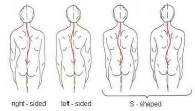 Types of scoliosis