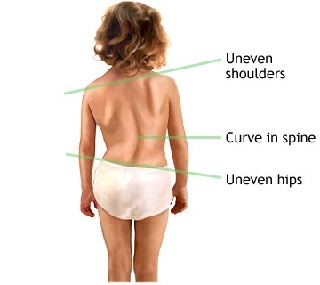 What causes scoliosis